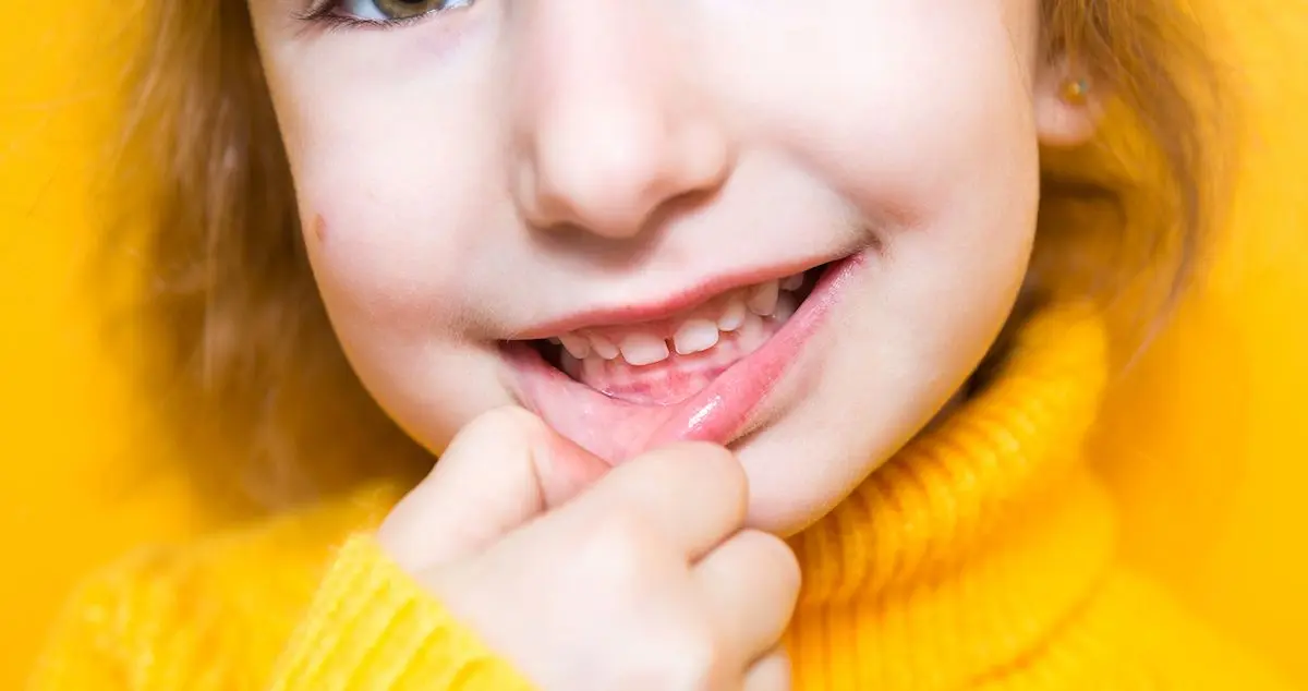 menton retraido ortodoncia - Cómo curar mandíbula Retraida