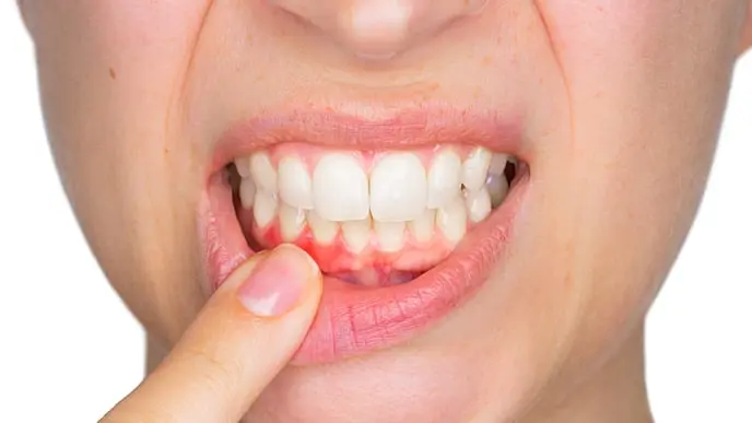 como curar la gingivitis sin ir al dentista - Cómo desinflamar las encías con gingivitis