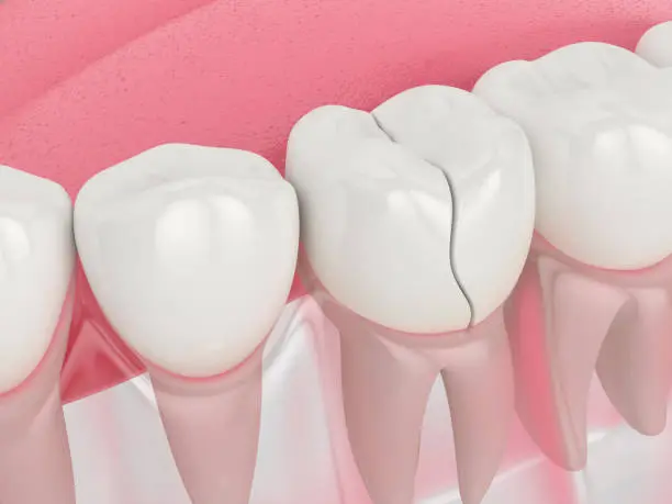 diente astillado - Cómo fortalecer los dientes astillados