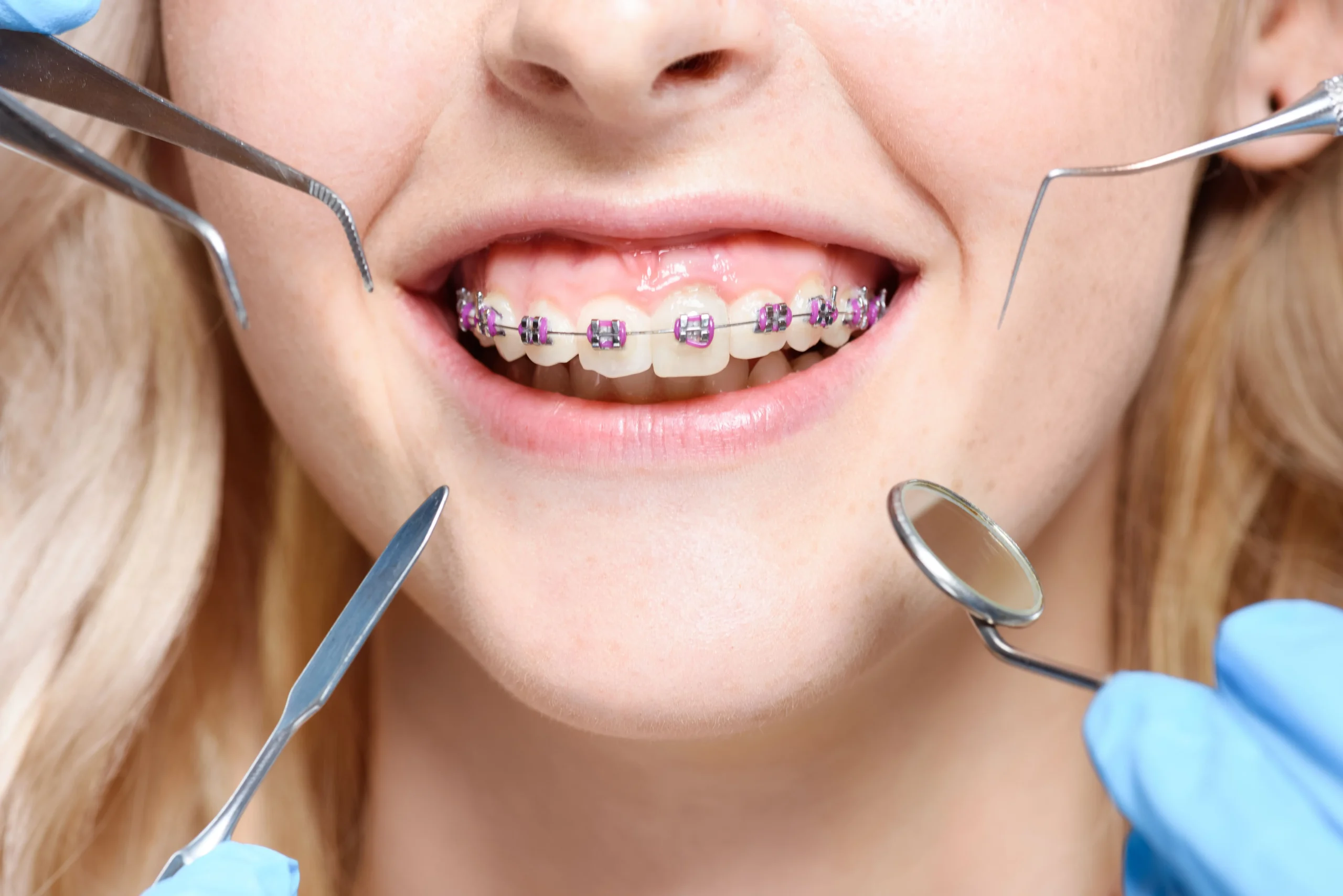 ortodoncia en españa - Cómo le dicen a los brackets en España