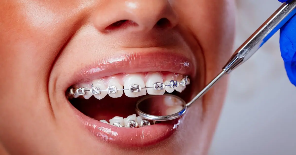 breaker dientes - Cómo poner breaker en los dientes