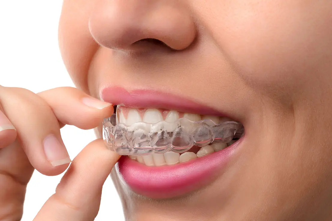 invisalign dientes - Cómo quedan los dientes con Invisalign