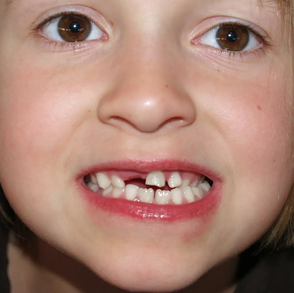 como sacar un diente a un niño - Cómo quitar el diente sin dolor