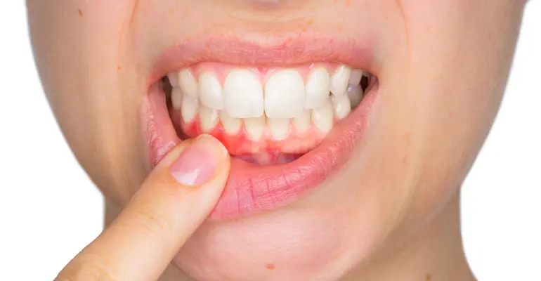 como calmar el dolor de dientes y encias - Cómo quitar el dolor de encías rápidamente