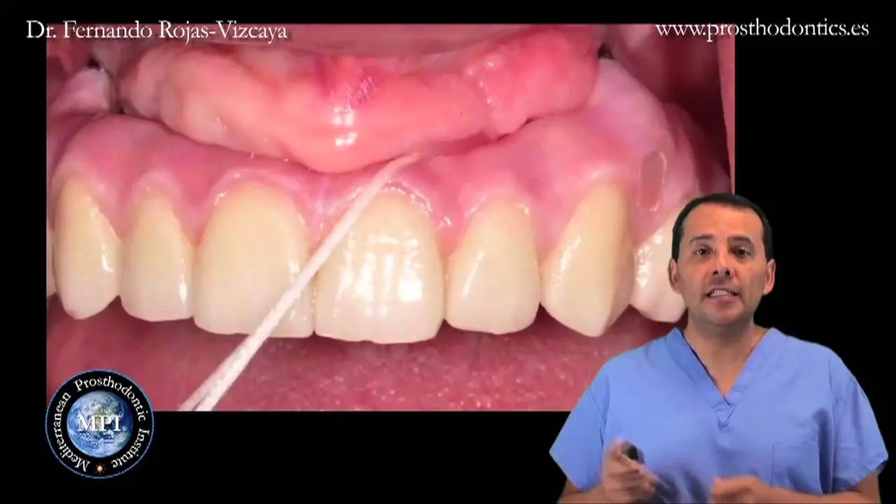 como limpiar dientes postizos fijos - Cómo quitar el mal olor de las prótesis fijas dentales
