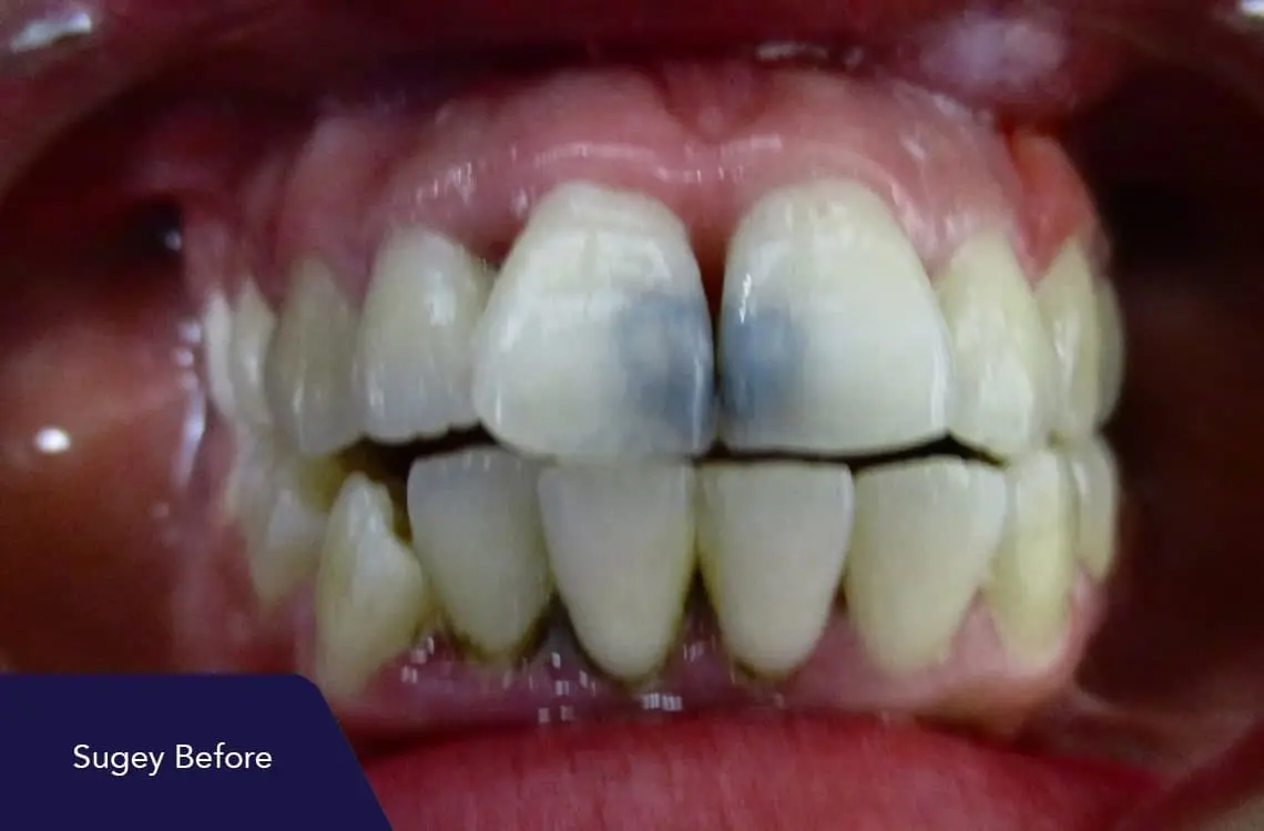 arreglo dientes delanteros - Cómo reemplazar un diente delantero