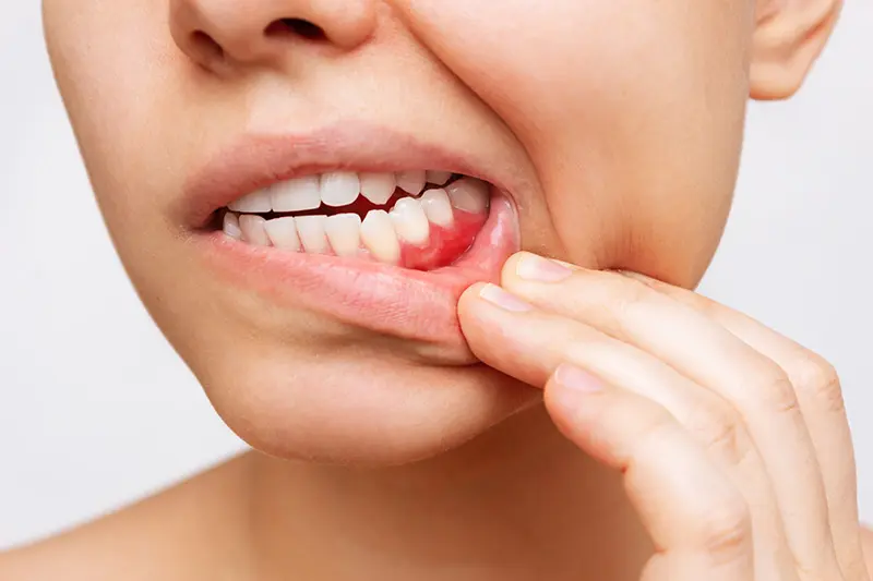 un diente flojo se puede apretar - Cómo salvar un diente que se mueve