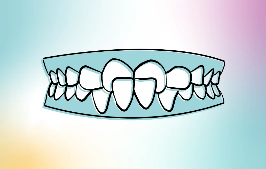 dientes cruzados - Cómo se corrige la mordida cruzada en adultos