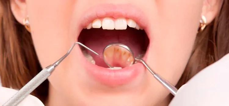 limpieza de dientes precio - Cómo se hace la limpieza de sarro en los dientes