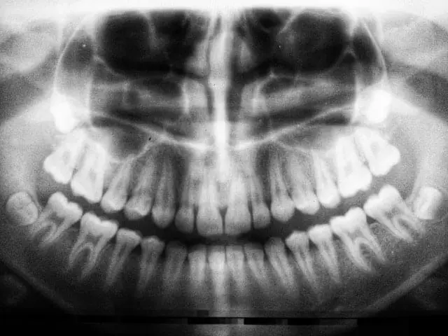 dientes grandes - Cómo se le llama a una persona con dientes grandes
