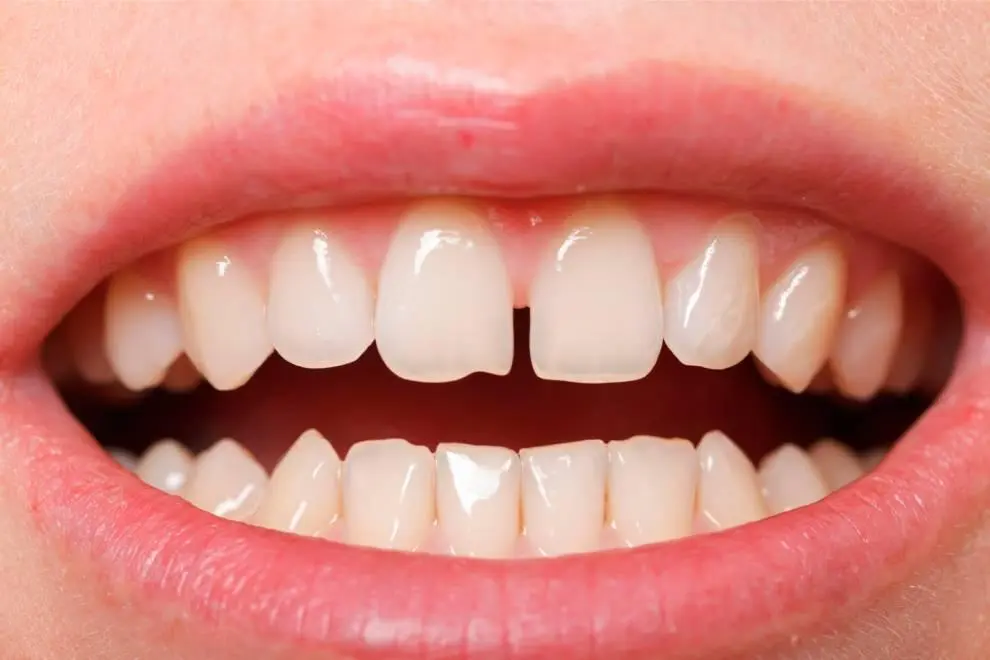 dientes separados - Cómo se llama a los que tienen los dientes separados