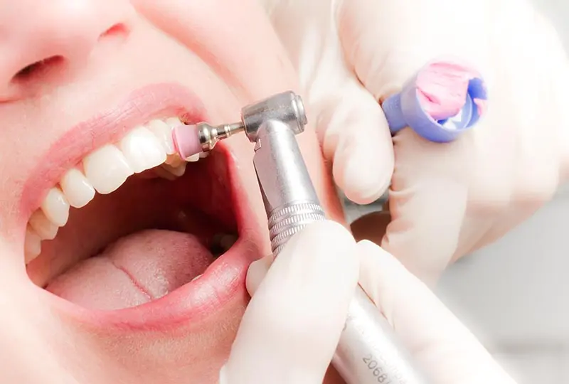 limpieza de dientes odontologia - Cómo se llama cuando el dentista te limpia los dientes