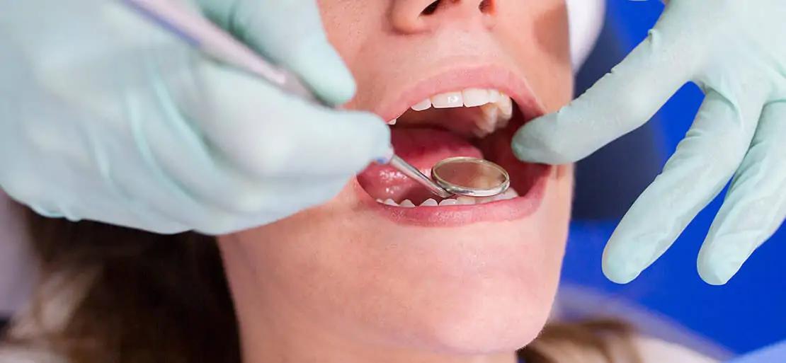 dientes superpuestos - Cómo se llama cuando los dientes están muy juntos