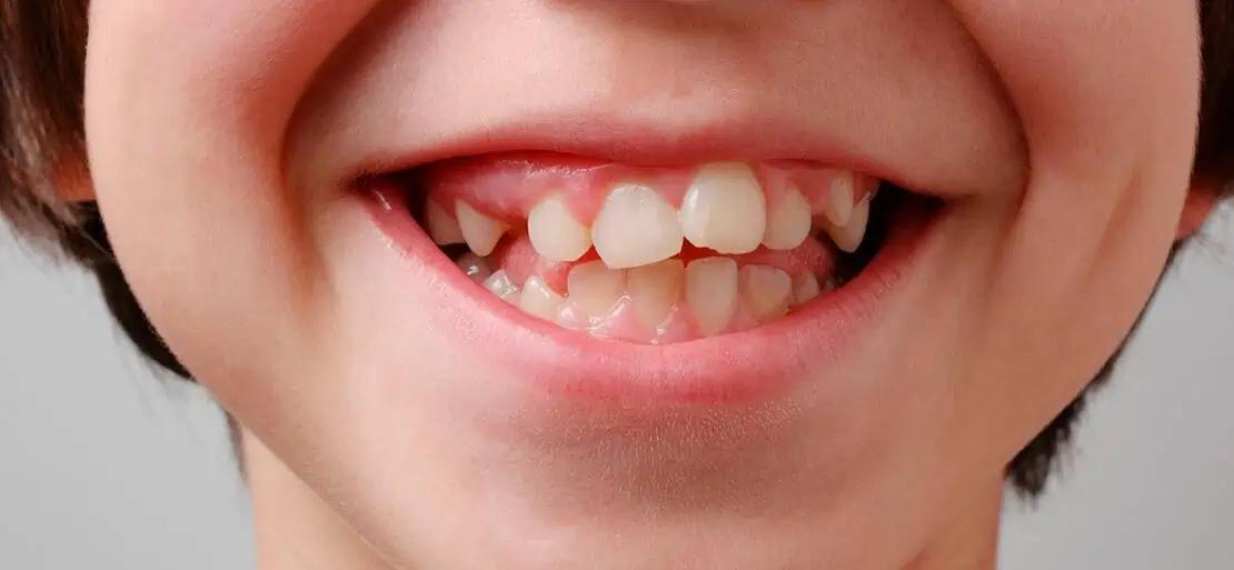 dientes para afuera - Cómo se llama cuando tienes los dientes salidos