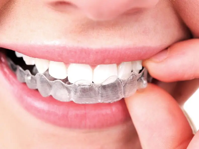 corrector de dientes transparente - Cómo se llama el plástico transparente para los dientes