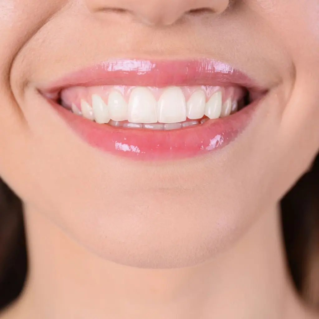 limar dientes antes y despues - Cómo se llama el procedimiento para emparejar los dientes