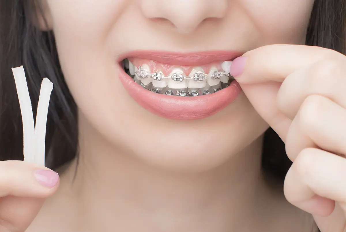 cera dental para ortodoncia - Cómo se llama la cera que se pone en los brackets