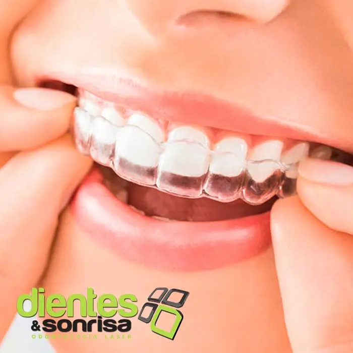 Ortodoncia sin brackets en argentina: solución discreta y efectiva