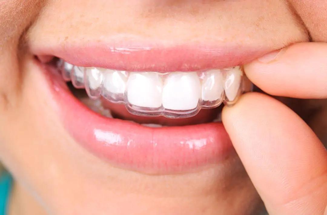 ortodoncia transparente - Cómo se llama la ortodoncia transparente