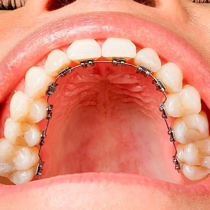 Ortodoncia por dentro: una alternativa estética para problemas dentales