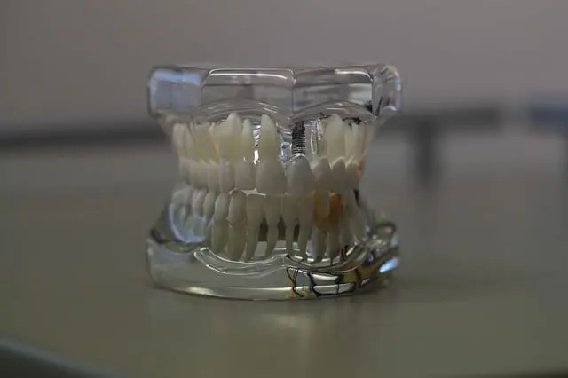 tornillos ortodoncia - Cómo se pone un tornillo en la boca