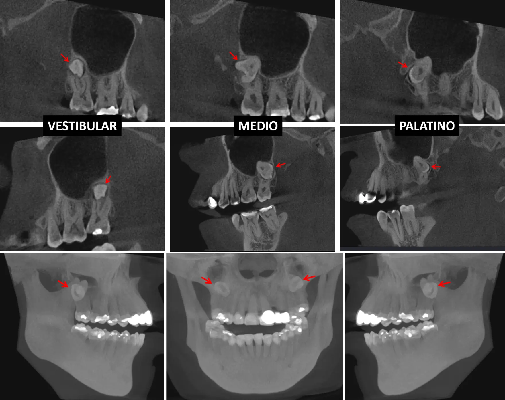 tomografia de dientes - Cómo se realiza una tomografía dental