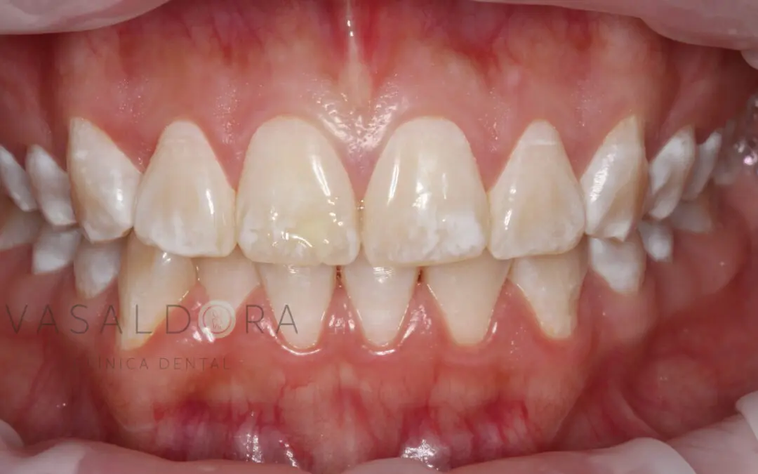 falta de calcio en los dientes de niños - Cómo se recupera el calcio de los dientes
