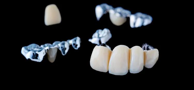 puente dientes - Cómo se sostiene un puente dental fijo