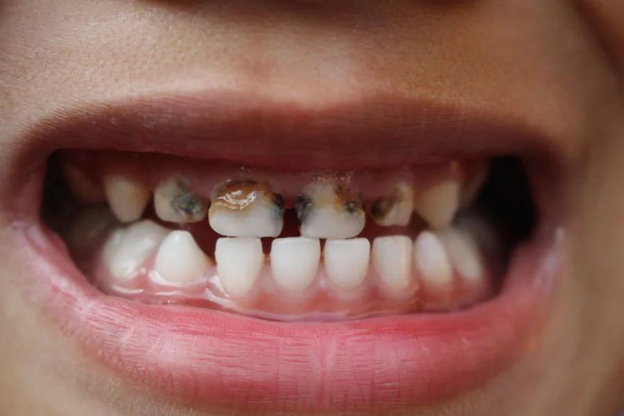 arreglo de dientes picados - Cómo se tapan los dientes picados