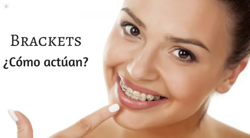 cuanto se mueven los dientes por mes con brackets - Cómo se van moviendo los dientes con brackets