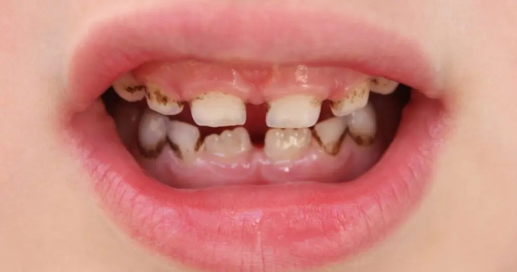 dientes con sarro negro - Cómo se ve el sarro negro en los dientes