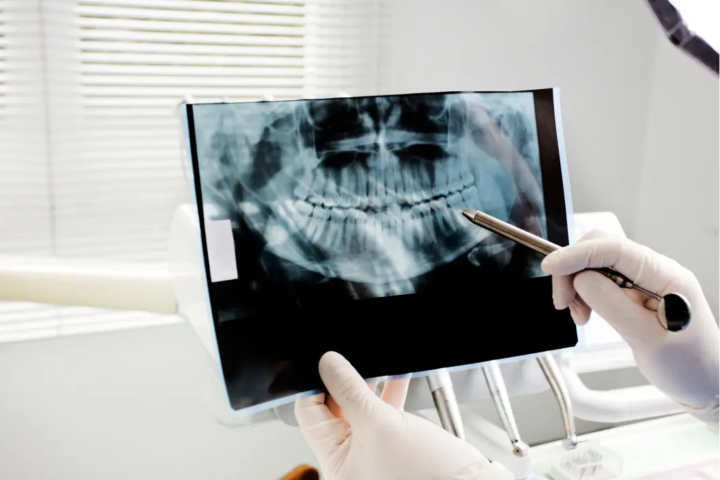 diente radiografia - Cómo se ve una radiografía de un diente con caries