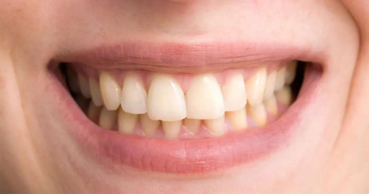 dientes amarillos es normal - Cuál es el color natural de los dientes