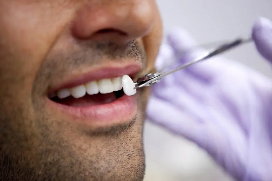 dentista carillas dentales - Cuál es el costo de las carillas dentales