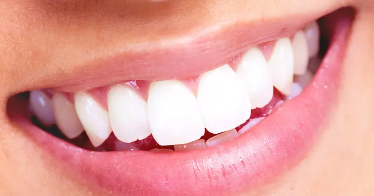 dientes de metal - Cuál es el mejor material para los dientes