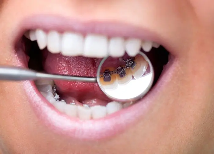 brackets para enderezar los dientes - Cuál es el mejor tratamiento para enderezar los dientes