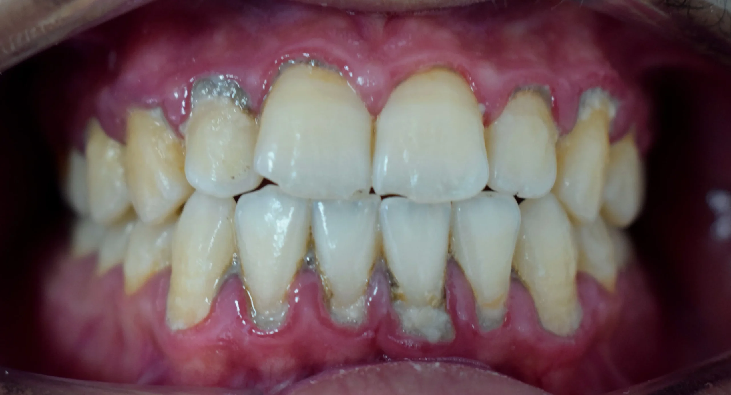 placa en los dientes - Cuál es la diferencia entre placa y sarro