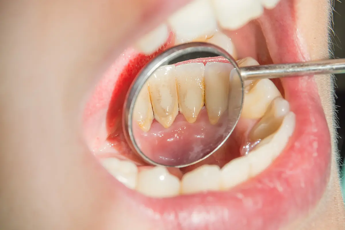 como evitar el sarro en los dientes de forma natural - Cuál es la mejor fruta para eliminar el sarro dental