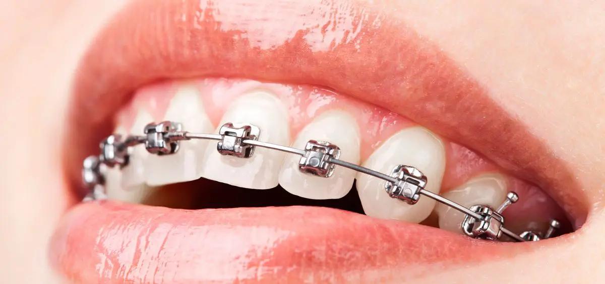 brackets en dientes pequeños - Cuáles son los brackets mini