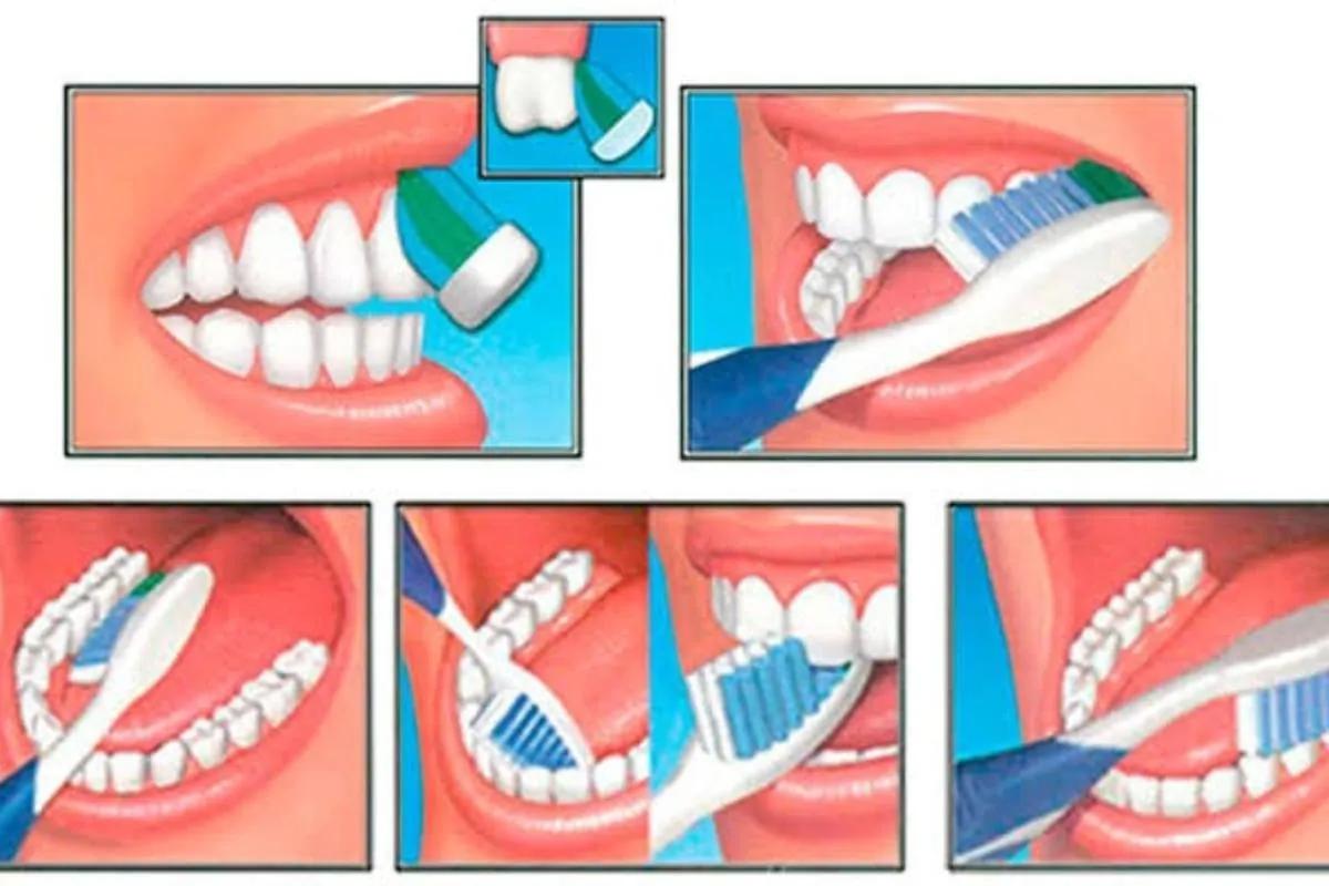 pasos del cepillado de dientes - Cuáles son los pasos para un correcto cepillado dental