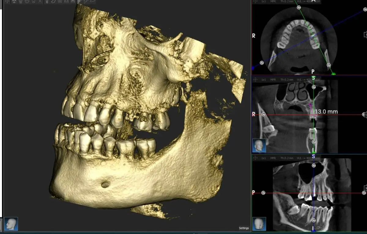 tomografia de dientes - Cuándo es necesaria una tomografía dental