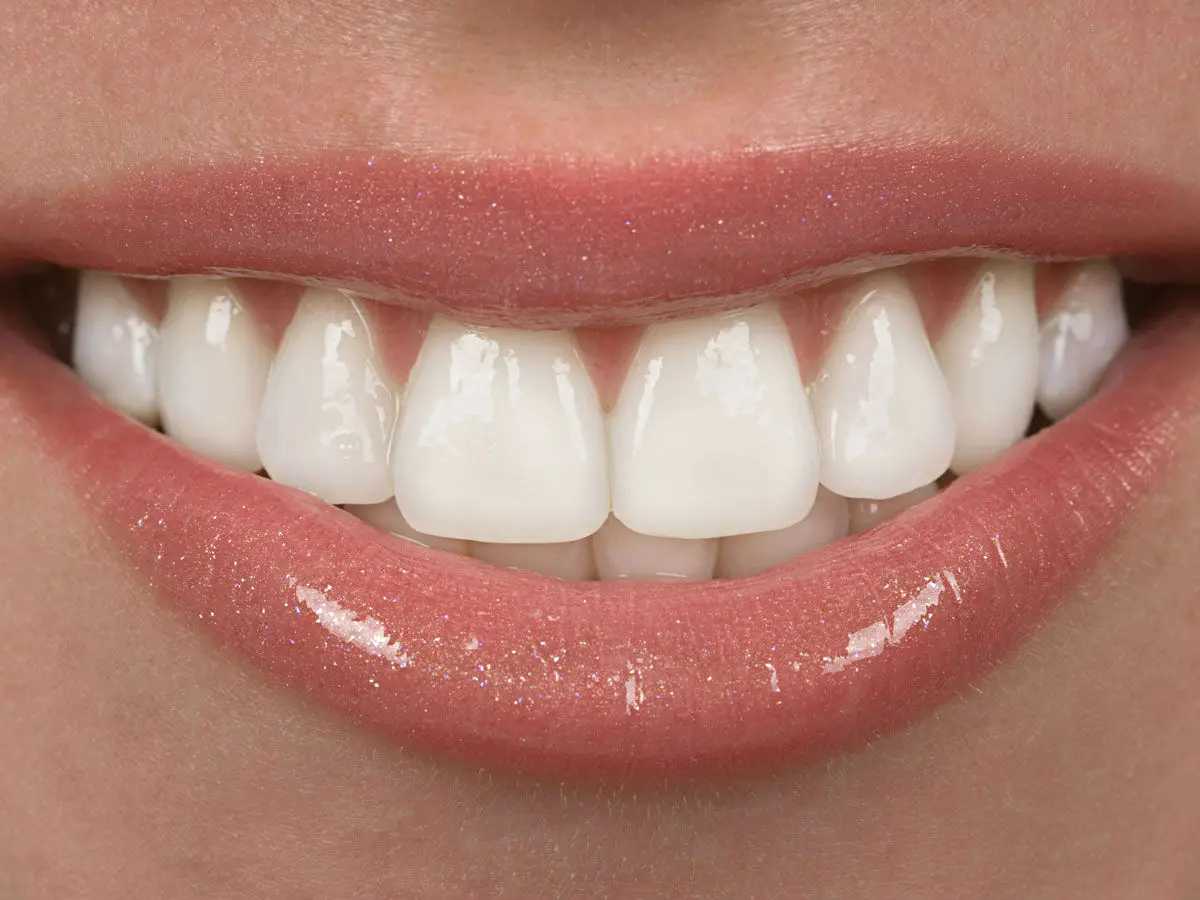 limado de dientes - Cuándo se liman los dientes