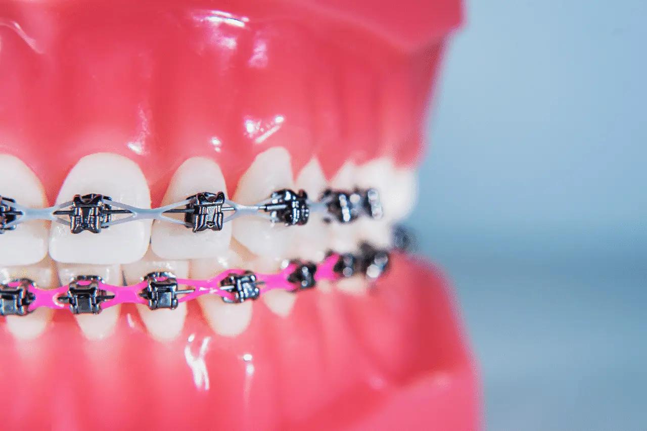 hook ortodoncia - Cuando te ponen la cadeneta en los brackets