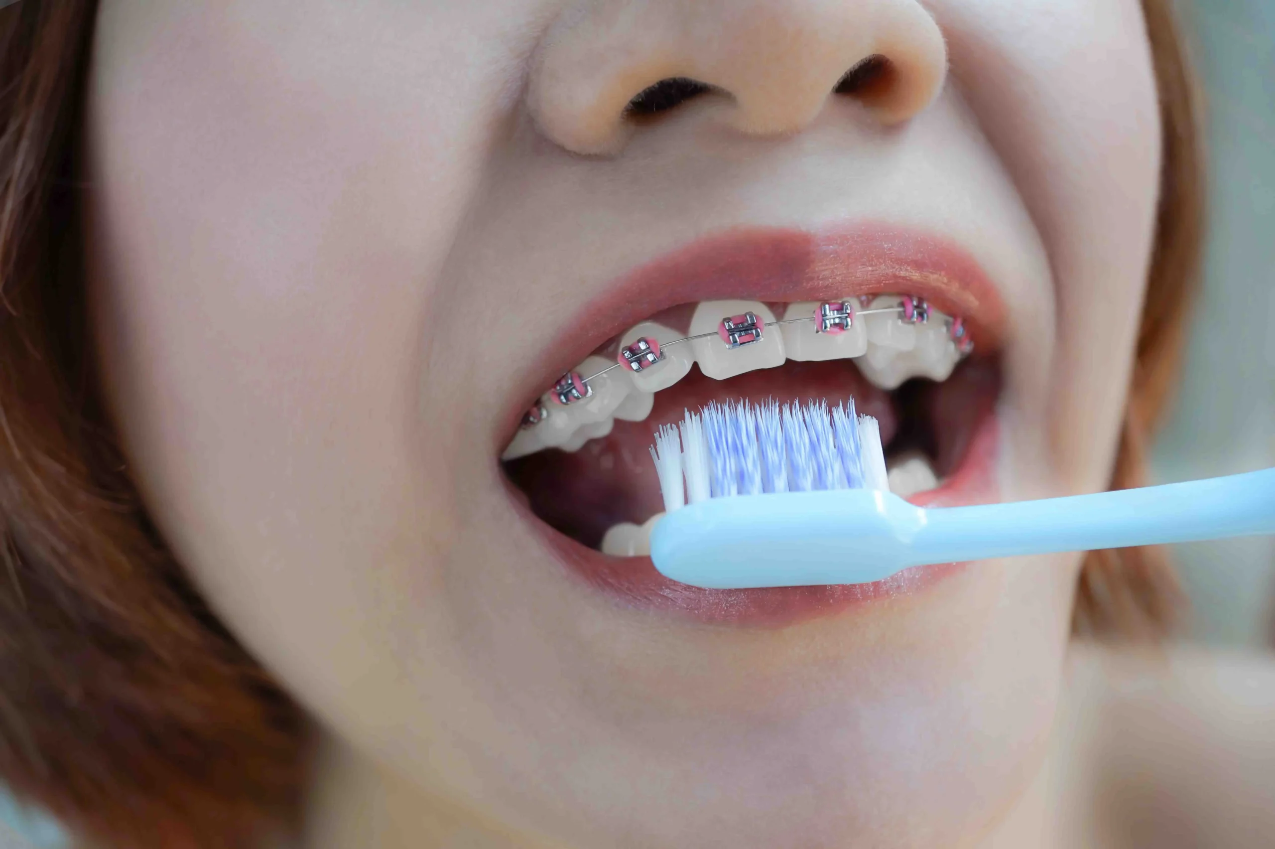 limpieza ortodoncia - Cuando te ponen los brackets te hacen una limpieza