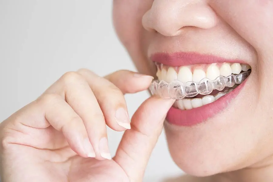 corregir dientes torcidos - Cuánto cobran por enderezar los dientes