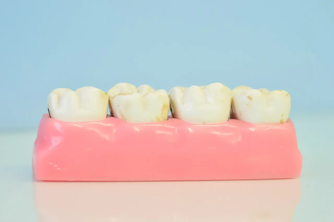como se implanta un diente - Cuánto cuesta implantarse dientes