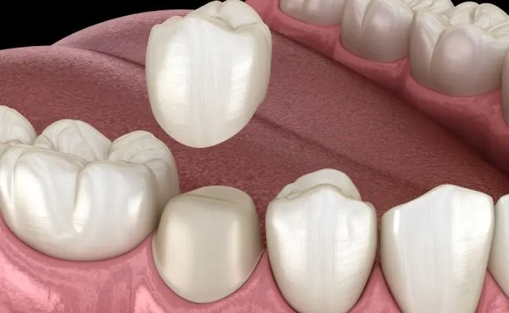 coronita en los dientes - Cuánto cuesta la corona para los dientes