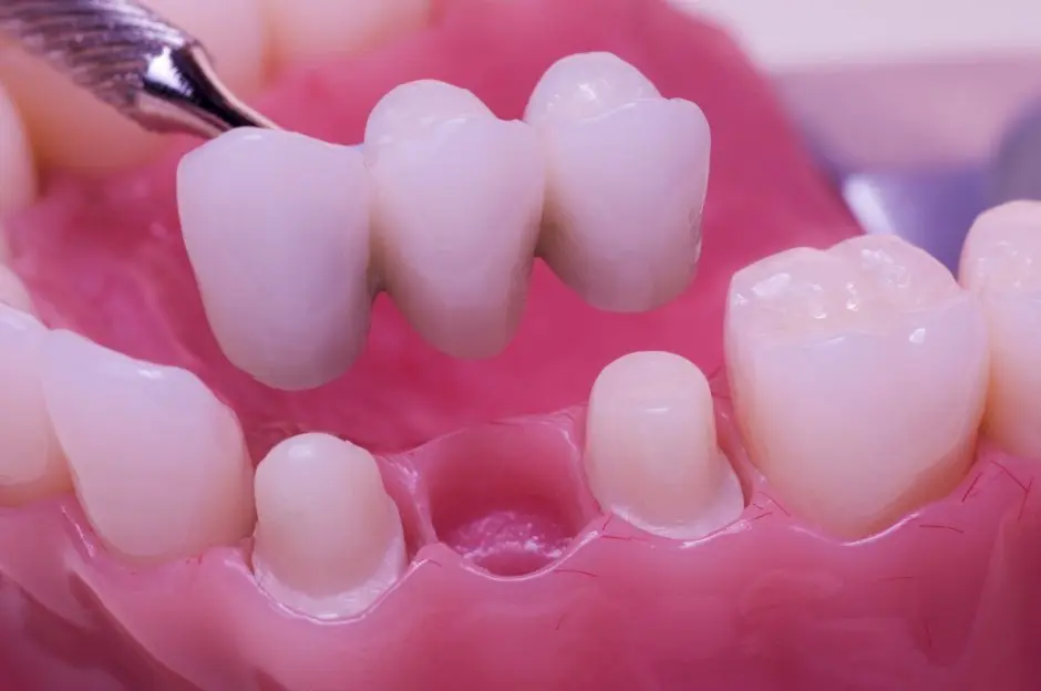 colmillos de vampiro dentista precio - Cuánto cuesta poner un puente dental