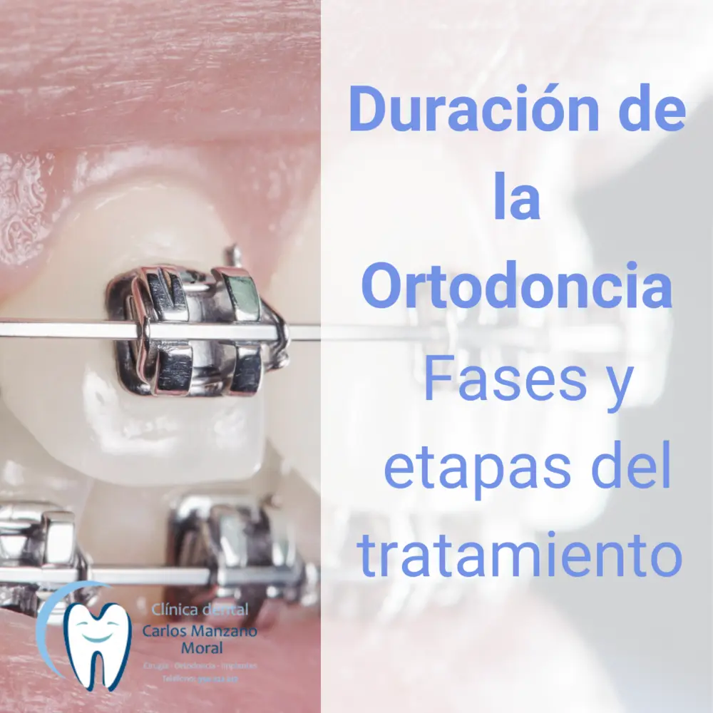 Cómo cerrar un diastema dental: opciones de tratamiento