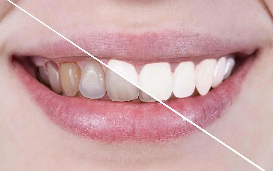 blanqueamiento de dientes dentista - Cuánto dura un blanqueamiento dental en el dentista